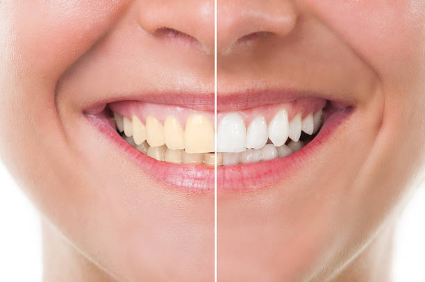 vor und nach der zahnaufhellung - menschlicher zahn fotos stock-fotos und bilder