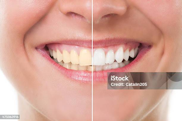 Before And After Whitening Stock Photo - Download Image Now - Tooth Whitening, White Color, White People