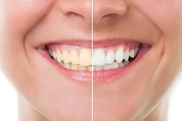 Photo of Before and after whitening