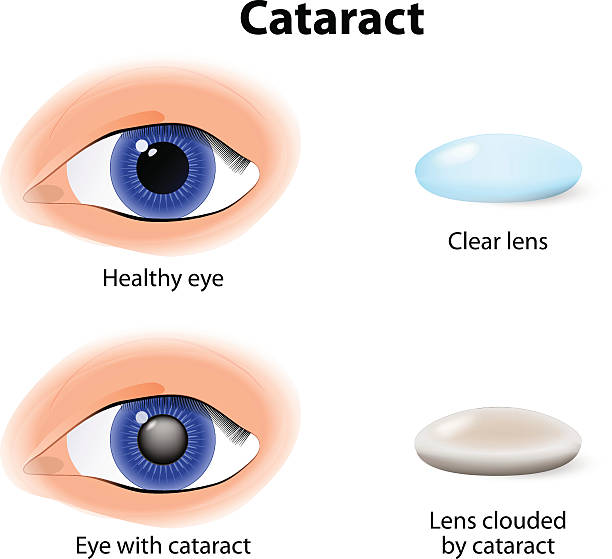 illustrazioni stock, clip art, cartoni animati e icone di tendenza di la cataratta è un annebbiamento del cristallino - cataratta