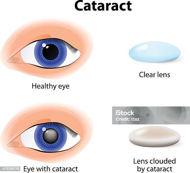 Cataract Explained Cataract Is An Clouding Crystalline Lens Stock Illustration - Download ...