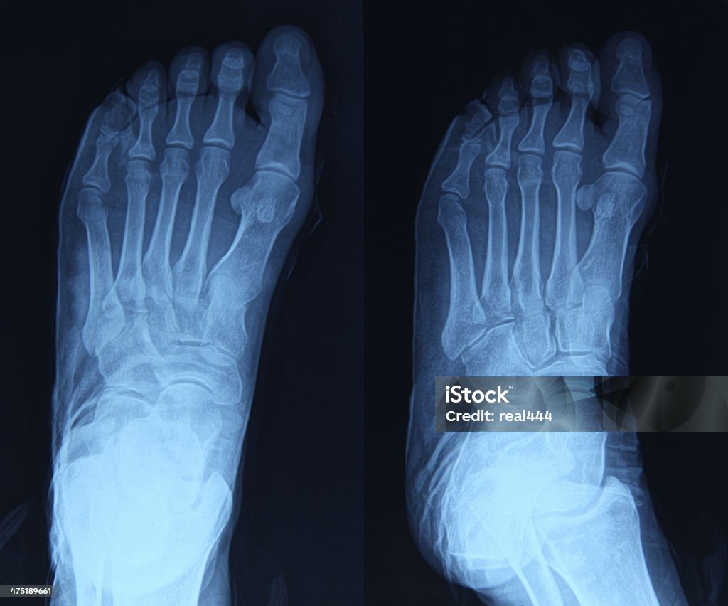 Imagerie par rayons X des pieds - Photo de Anatomie libre de droits