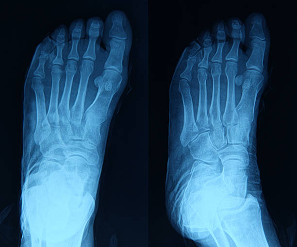 imagem de raios x do pé - bending human foot ankle x ray image - fotografias e filmes do acervo