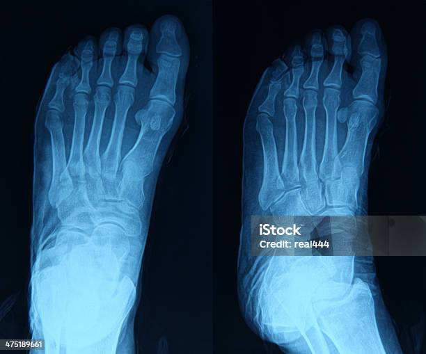 Foto de Imagem De Raios X Do Pé e mais fotos de stock de Anatomia - Anatomia, Articulação Humana - Termo anatômico, Articulação humana