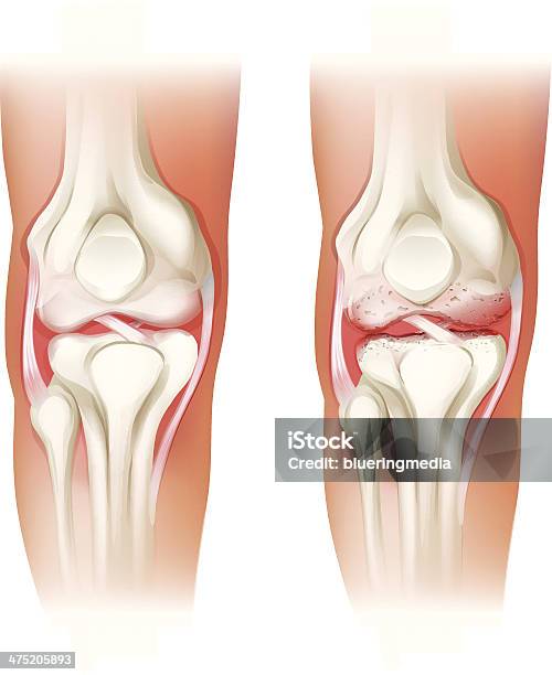 人間の膝関節 - 関節のベクターアート素材や画像を多数ご用意 - 関節, 変形性関節症, 関節リウマチ