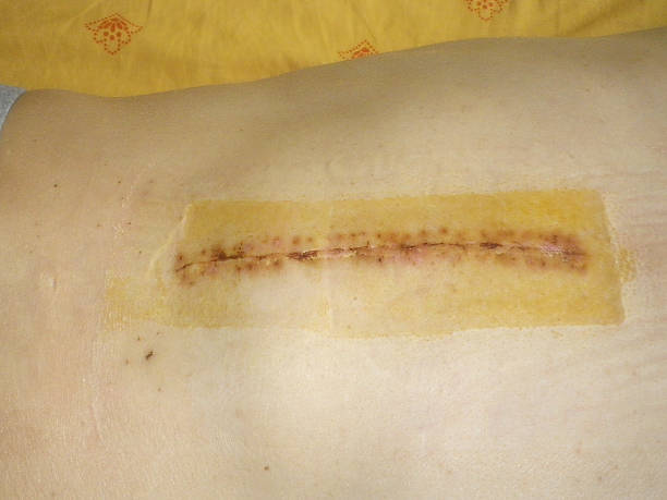 Scar after a surgical operation Post operative staples ten days after a surgical operation of the vertebral column scar surgery rear view human spine stock pictures, royalty-free photos & images