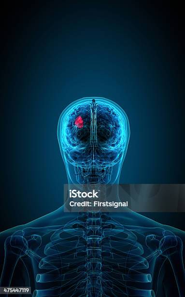 Xray Z Mózgu Wskazujące Guza - zdjęcia stockowe i więcej obrazów Anatomia człowieka - Anatomia człowieka, Choroba, Ciało ludzkie