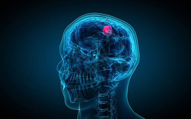 istock x-ray of brain showing tumor 475447143