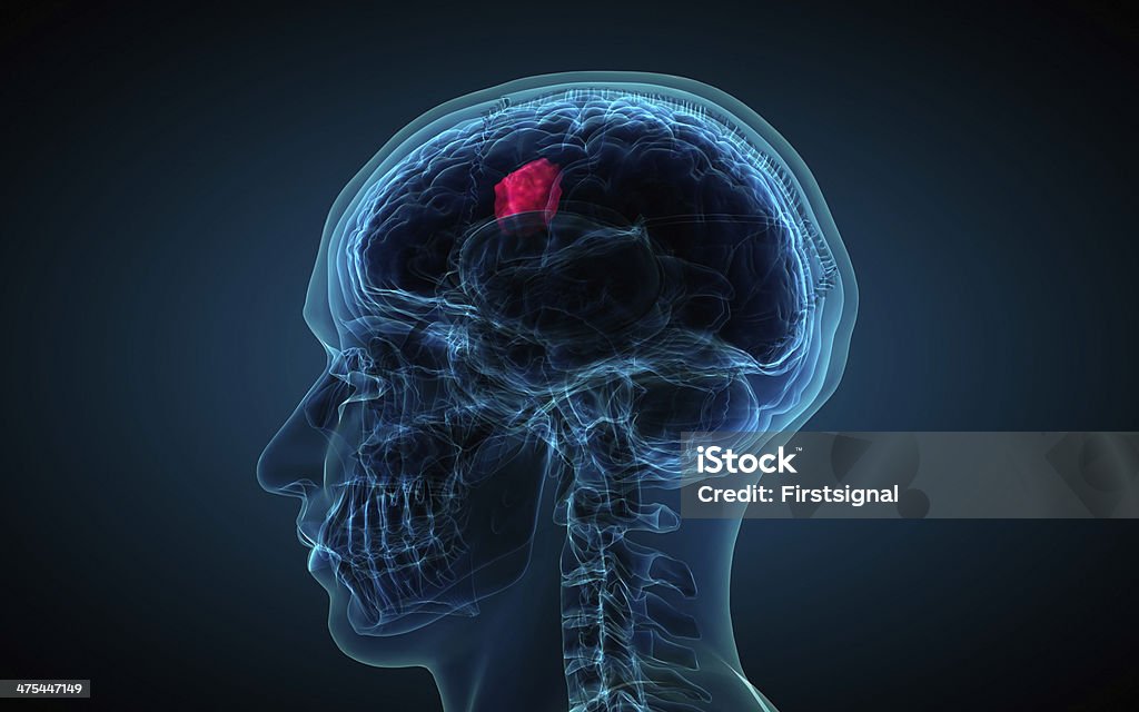 Raios-x do cérebro mostrando tumor - Royalty-free Tumor cerebral Foto de stock