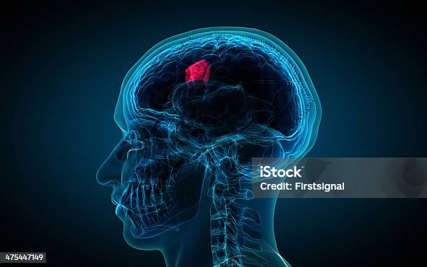 Raiosx Do Cérebro Mostrando Tumor - Fotografias de stock e mais imagens de Tumor cerebral - Tumor cerebral, Cancro, Cérebro humano