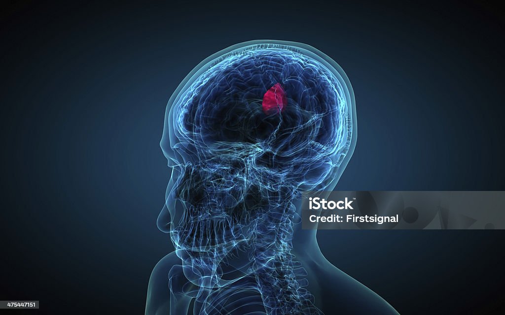 x-ray de cerveau montrant bénigne - Photo de Adulte libre de droits