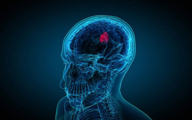 istock x-ray of brain showing tumor 475447151
