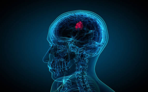 istock x-ray of brain showing tumor 475447161