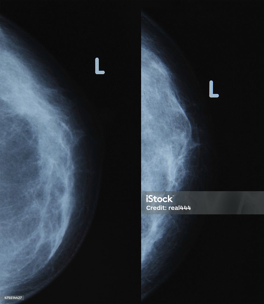 Imagerie par rayons X de au téton - Photo de Cancer libre de droits