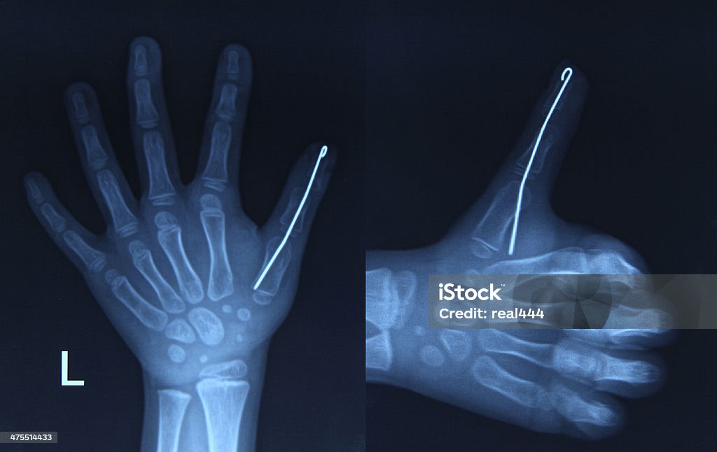 X-ray image hands Anatomy Stock Photo