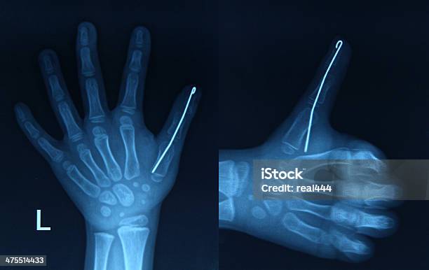 Xray Image Hands Stock Photo - Download Image Now - Anatomy, Arthritis, Artificial Joint