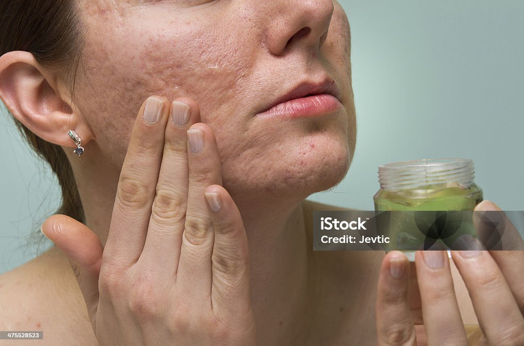 Acne therapy Girl applying aloe gel to problematic skin with acne scars Moisturizer Stock Photo