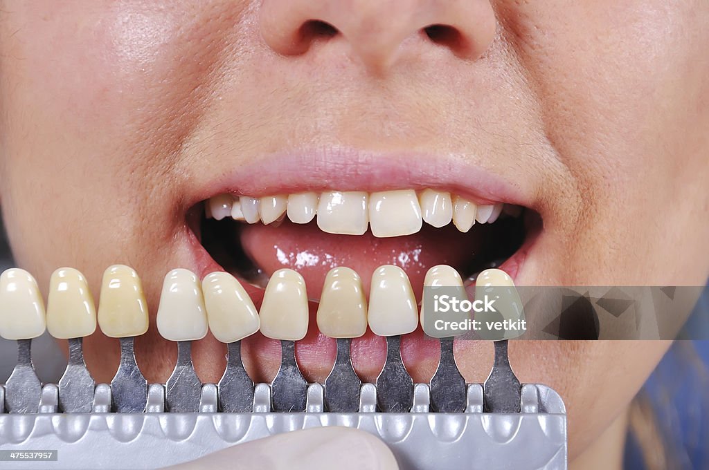 shade determination tooth shade determination tooth with help of a shade guide Adult Stock Photo