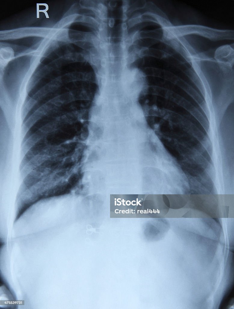 Imagem de raio-X do tórax - Royalty-free Articulação - Parte do corpo Foto de stock