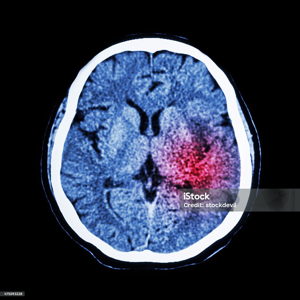 CT scan of brain show Ischemic Stroke or Hemorrhagic Stroke Stroke - Illness Stock Photo