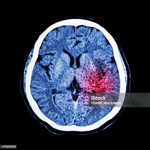 Ct Scan Of Brain Show Ischemic Stroke Or Hemorrhagic Stroke Stock Photo - Download Image Now