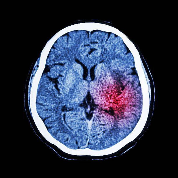ct scan of brain show ischemic stroke or hemorrhagic stroke - brain scan' bildbanksfoton och bilder