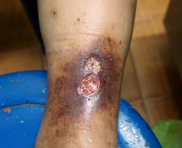 Chronic venous leg ulcer Chronic venous leg ulcer was open for dressing with normal saline. human limb stock pictures, royalty-free photos & images
