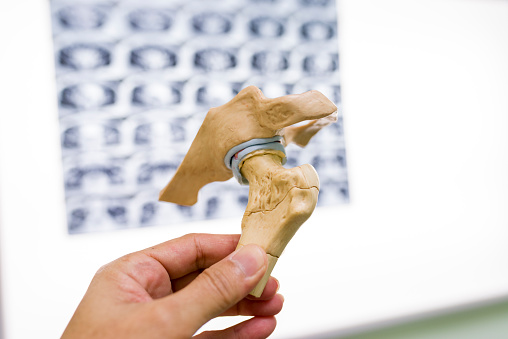 Close up of man's hand holding a Hip Joint Model, illustrating of degenerative joint diseases (osteoarthritis and osteoporosis).