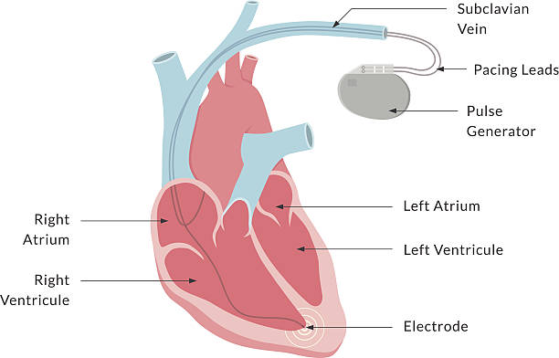 herzschrittmacher mit label - herzschrittmacher stock-grafiken, -clipart, -cartoons und -symbole
