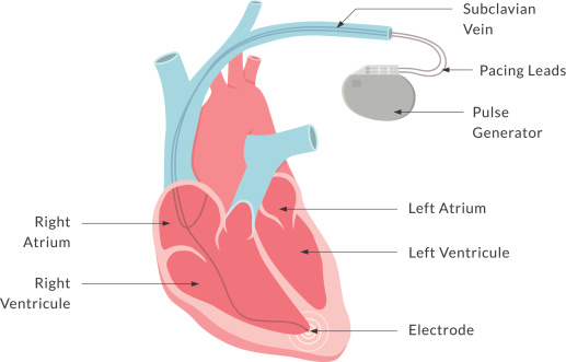 Diagram of a dual-chamber / double lead pacemaker with key parts labelled. This is an EPS 10 vector illustration and comes with a high resolution JPEG.