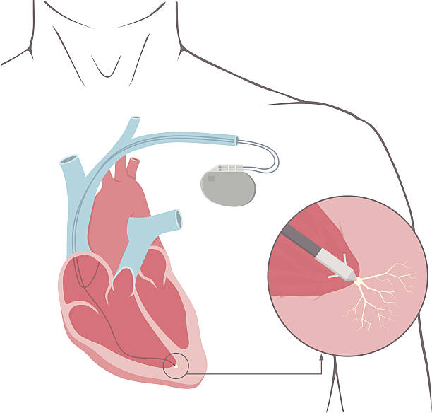 박동조율기 - pacemaker torso chest male stock illustrations