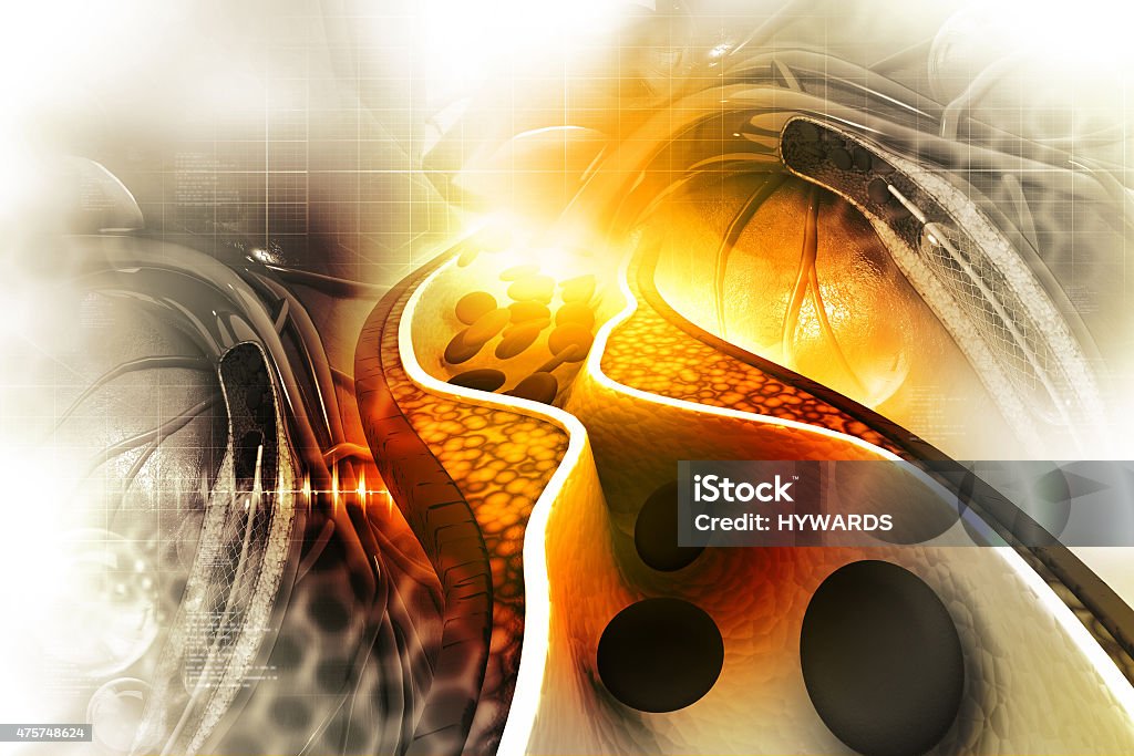 Cholesterol plaque in artery Abstract Stock Photo