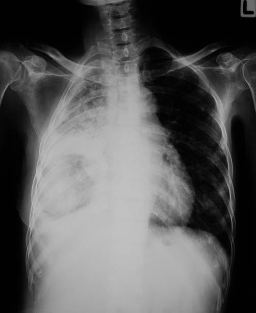 胸 x 線画像の肺の感染症も含む。 - pain rib cage x ray image chest ストックフォトと画像