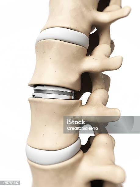 Disco Artificiale - Fotografie stock e altre immagini di Ortopedico - Ortopedico, Anatomia umana, Bianco