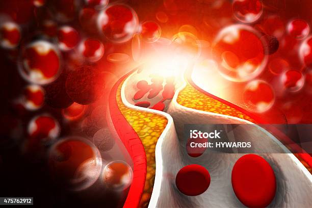 Cholesterol Plaque In Artery Stock Photo - Download Image Now - Cholesterol, Arteriosclerosis, 2015