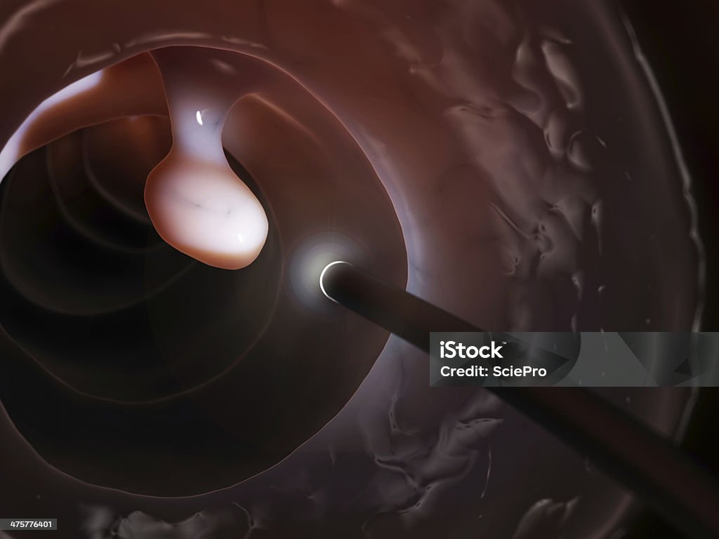 polyp removal 3d rendered illustration of a colonoscopy Colonoscopy Stock Photo