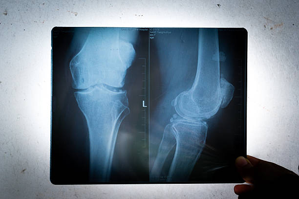 Os médicos constituem um joelho idosos com osteoartrite em raios X - fotografia de stock