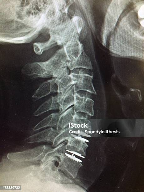 Two Level Disc Replacement Two Level Cervical Artificial Disc Replacement Stock Photo - Download ...