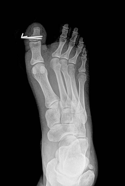 x-ray film x-ray show fracture proximal phalange at first toe pollex stock pictures, royalty-free photos & images