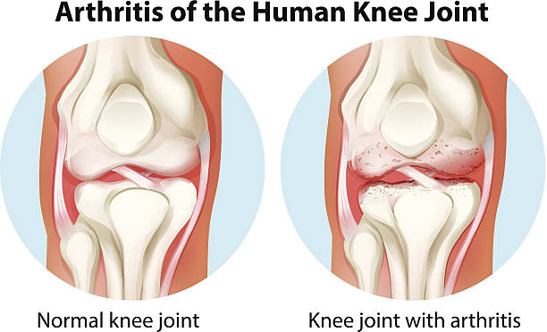 illustrazioni stock, clip art, cartoni animati e icone di tendenza di artrite dell'articolazione del ginocchio umano - pain human knee arthritis human joint
