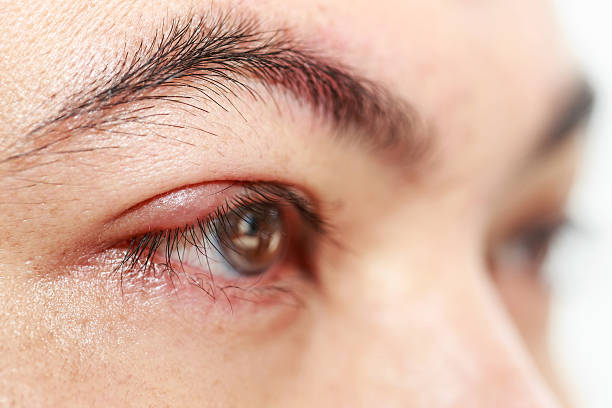 istock Right upper eye lid abscess 