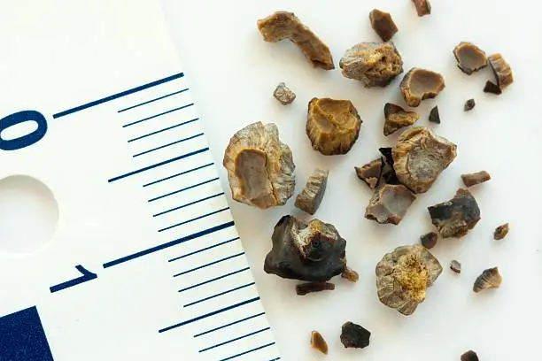 Photo of Kidney stones after ESWL intervention