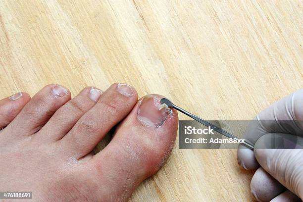 Plucking Nail Stock Photo - Download Image Now - Adult, Bacterium, Barefoot