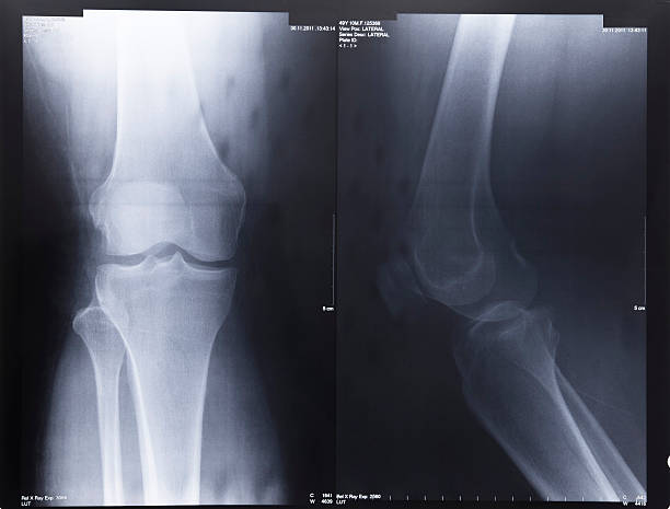 무릎 x-선 - x ray human knee orthopedic equipment human bone 뉴스 사진 이미지