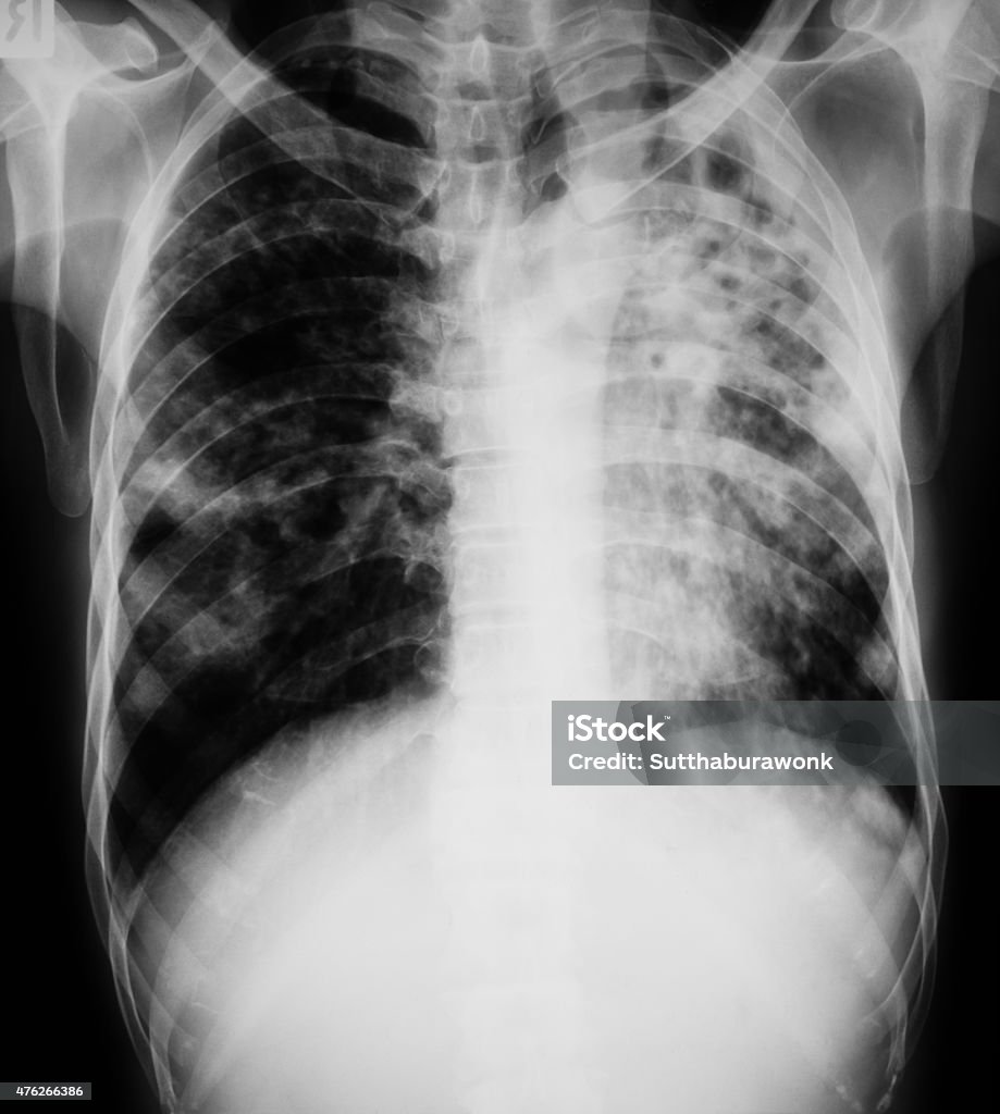 Peito imagem de raio-x do paciente com pulmonar a tuberculose. - Foto de stock de Ultrasonografia Médica - Instrumento para Diagnóstico royalty-free