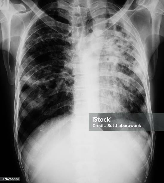Foto de Peito Imagem De Raiox Do Paciente Com Pulmonar A Tuberculose e mais fotos de stock de Ultrasonografia Médica - Instrumento para Diagnóstico