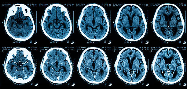 istock CT scan of brain without and with contrast media. 476354990