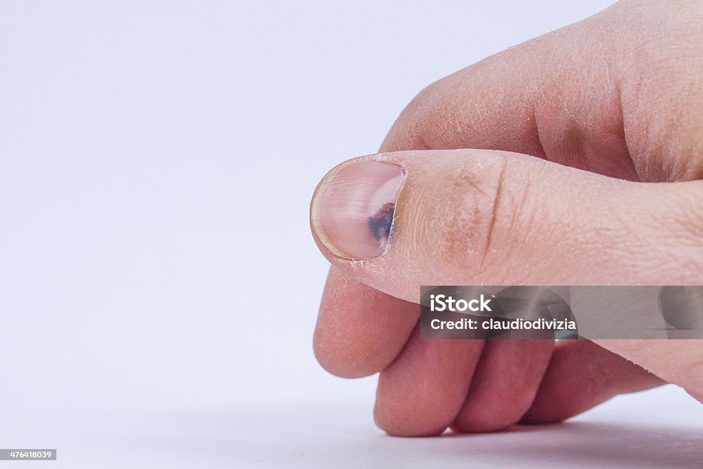 Subungual hematoma unter Nagel - Lizenzfrei Fingernagel Stock-Foto