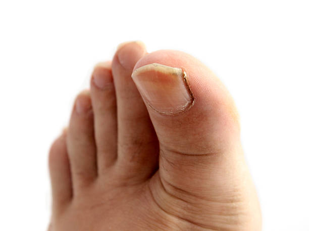 unhas na perna - fungus toenail human foot onychomycosis - fotografias e filmes do acervo