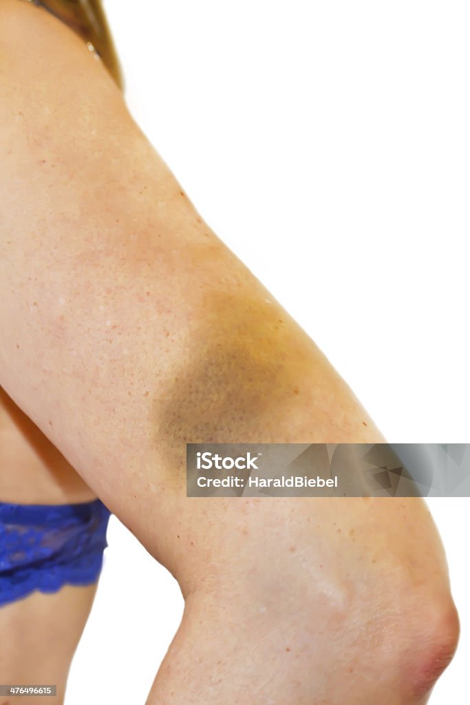 Mulher com um hematoma no seu braço esquerdo - Foto de stock de Abuso royalty-free